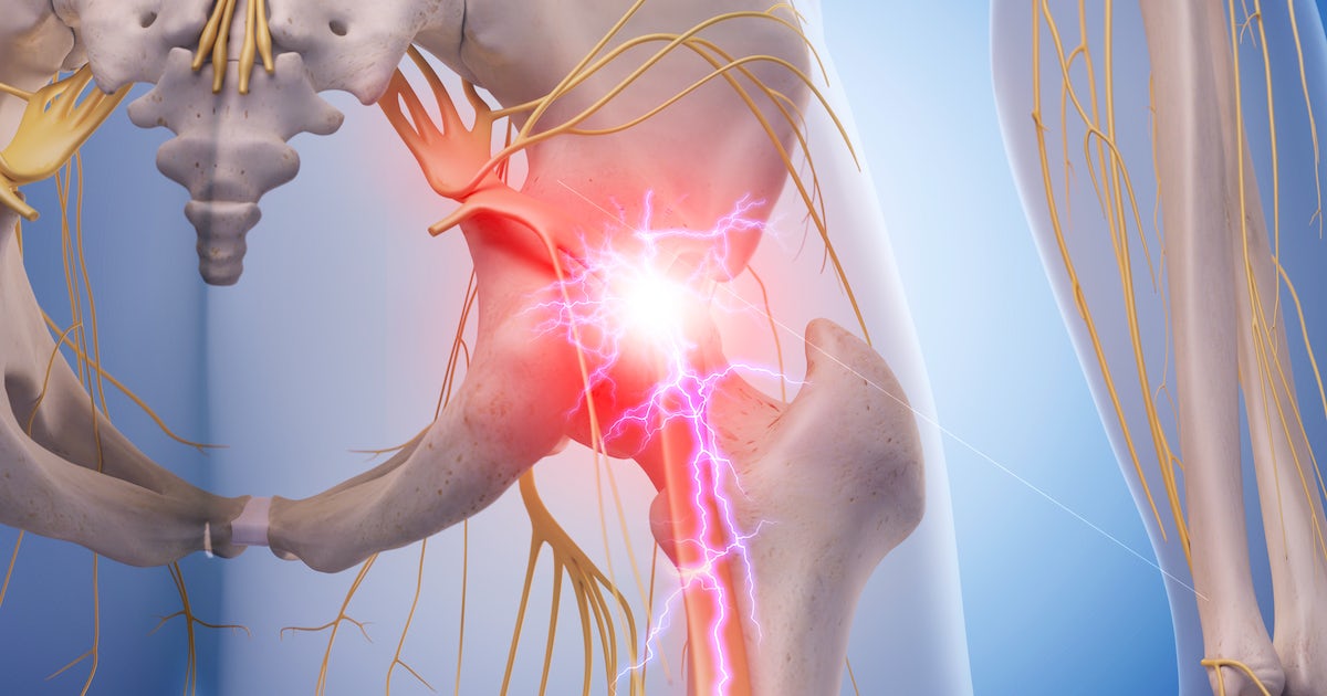medical illustration of inflamed sciatic nerve